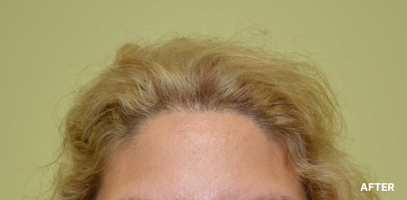 before image