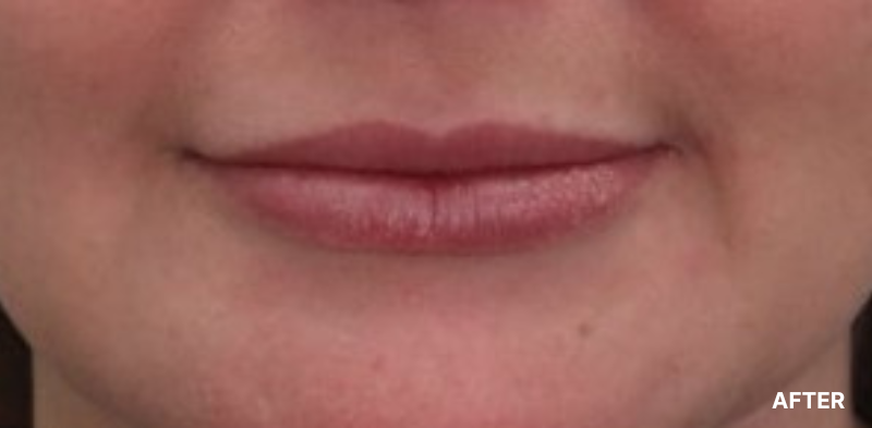 before image