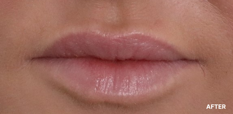 before image