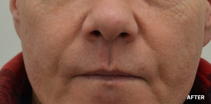 before image