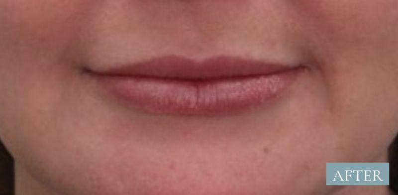 before image